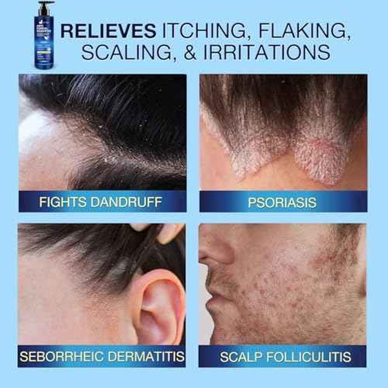 Anti-Fungal Shampoo for Scalp Psoriasis: Dandruff Shampoo for Folliculitis and Seborrheic Dermatitis - Relieves Itchy & Dry Scalp - 300 mL / 10.1 fl.oz