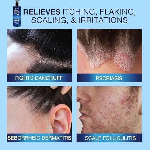 Uttse Anti-Fungal Shampoo for Scalp Psoriasis & Dandruff Relief - 300 mL