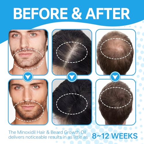 Minoxidil Hair Growth Serum for Men & Women - 180ml Pack of 3 - Thinning Hair Treatment