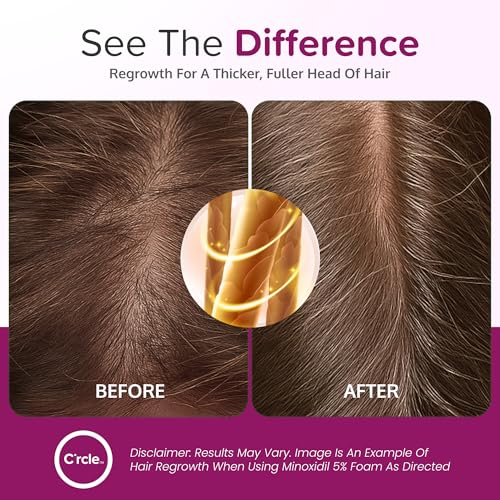 Minoxidil for Women 5% Foam - Unscented 2.11 Fl Oz Pack of 2, Supports Hair Growth