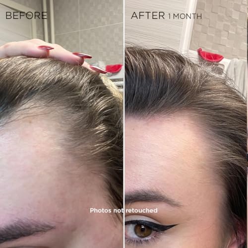 PHYTOCYANE Women Hair Loss Treatment Serum New Pack - Supports Fuller, Shinier Hair