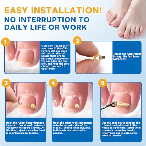 Ingrown Toenail Corrector Kit with Rubber Bands - Pain Relief & Nail Support