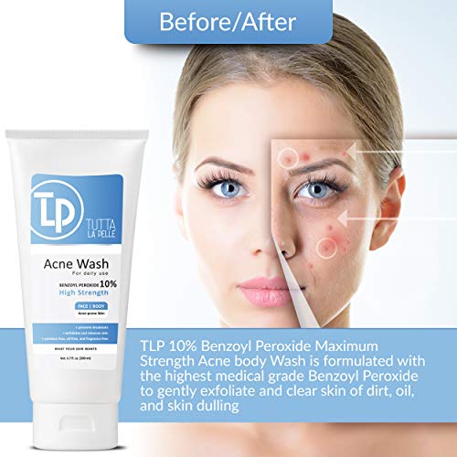 Tutta La Pelle Benzoyl Peroxide 10% Body Wash - Maximum Strength Acne Cleanser 6.7 oz