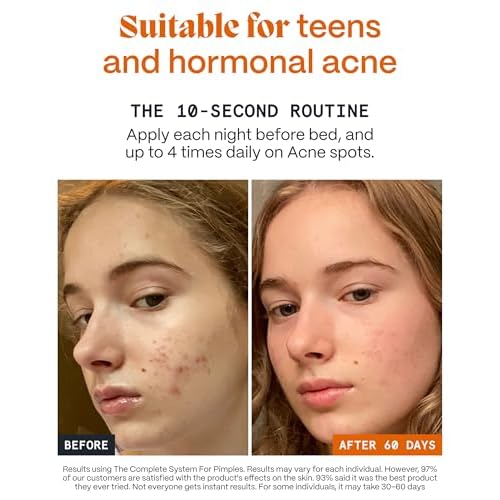 Norse Organics Pimple Stopper Night Balm | Acne Spot Treatment for Redness and Soothing Skin | Natural Bioactive Ingredients Help Treat Blemishes and Breakouts | Dermatologist Approved Skincare | 1 oz