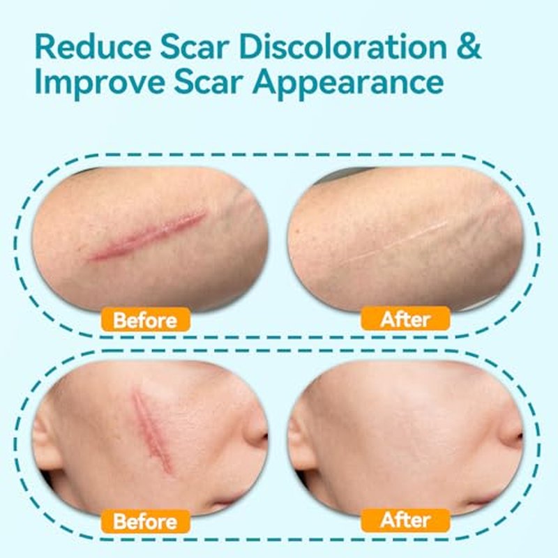 Dimora UPF50+ Silicone Scar Sheets with UV Protection Reusable Sheets to Soften, Flatten Fade Scars, Reduce Redness for Surgical, C-Section, Burn, Keloid, and Hypertrophic Scars (1.6¡±x78.7 Roll)