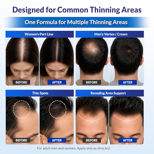 Minoxidil 5% Hair Regrowth Serum for Men & Women - 2 Pack with Dropper