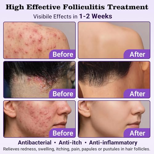 Folliculitis Treatment Cream - Natural Relief for Itching Redness & Inflammation - 3.53 Oz - Variation 1