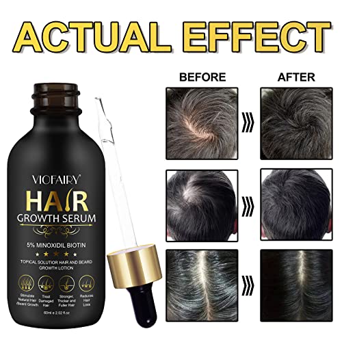 5% Minoxidil for Men and Women - Biotin Hair And Beard Growth Serum & 5% Minoxidil Treatment for Stronger Thicker Longer – Natural Growth Thickening Treatment - Stop Thinning & Hair Loss-1Month supply