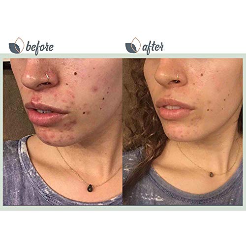 Mini 3-Piece Acne Treatment Set for Oily Skin - Vegan, Salicylic Acid, Green Gel