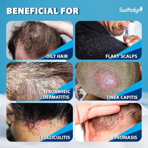 Swiftalyn Herbal Fresh Antifungal Shampoo for Seborrheic Dermatitis & Dandruff – Soothes Itchy Scalp