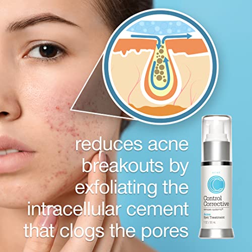 CONTROL CORRECTIVE Acne Spot Treatment Gel ? 2% Salicylic Acid Formula for Breakouts & Blemishes ? With Witch Hazel, Aloe & Panthenol ? 1 oz Clear Skin Serum