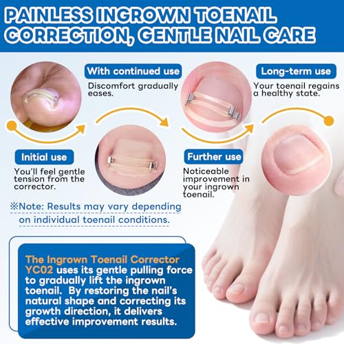 Ingrown Toenail Corrector Kit with Rubber Bands - Pain Relief & Nail Support