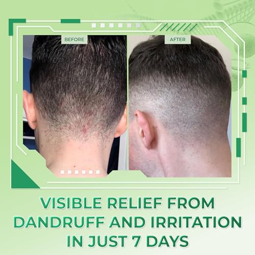 Atoskin Seborrheic Dermatitis & Dandruff Serum + Shampoo for Adults & Kids