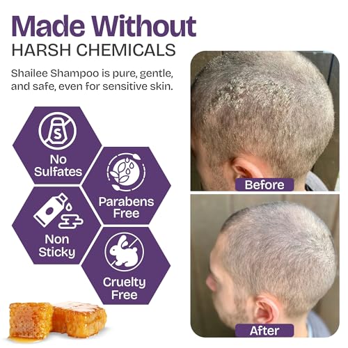 Psoriasis & Eczema Shampoo with Manuka Honey – 6.76 Fl Oz Pack of 2 for Flaking & Itchy Scalp