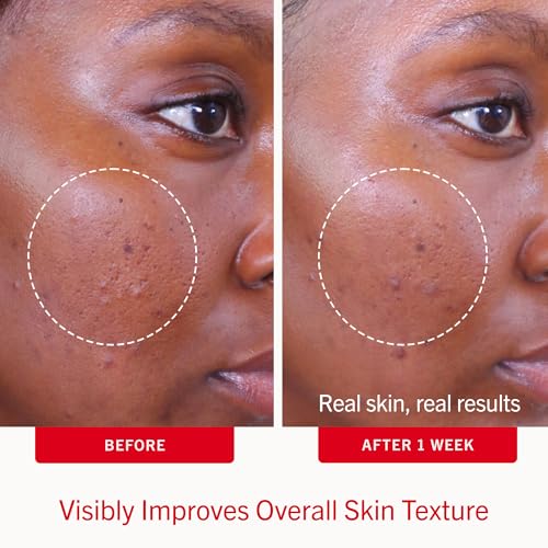 First Aid Beauty Acne Treatment Pads 2% Salicylic Acid - 28 Count