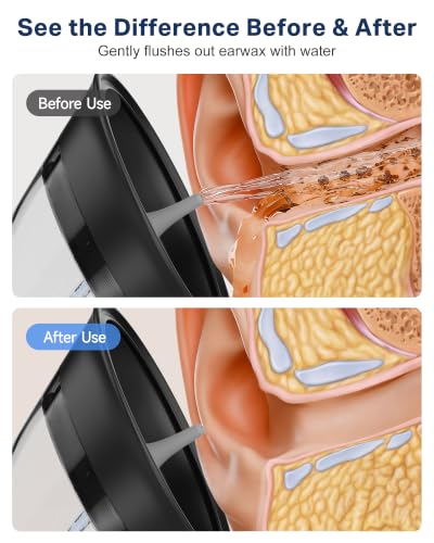 Renergy Ear Wax Removal System with Water Temp Sensor & Black Nozzles