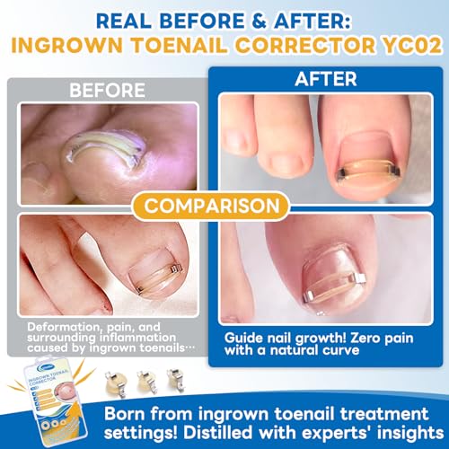Ingrown Toenail Corrector Kit with Rubber Bands - Pain Relief & Nail Support