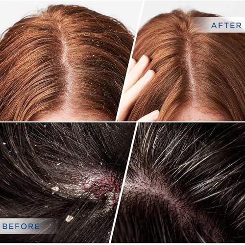 DERPHEA Medicated Scalp Shampoo for Psoriasis & Dandruff Relief - 8 fl oz