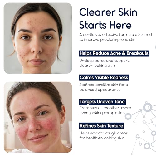Azelaic Acid 15 Acne Cream for Face - Redness Relief, Rosacea Treatment for Face - Soothes Acne, Hyperpigmentation, Enhanced Formula for Brighter, Healthier Skin Care