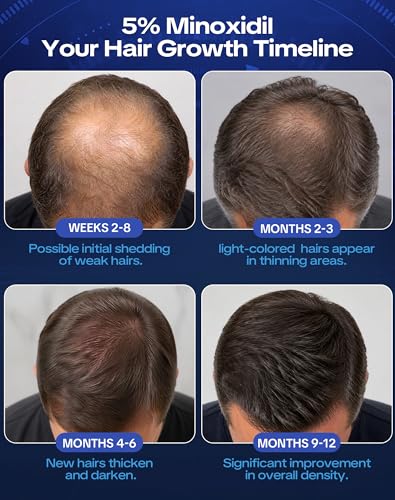 Minoxidil 5% Hair Growth Solution with Spray Nozzle for Men and Women - Thinning Hair & Beard Treatment, 2-Month Supply
