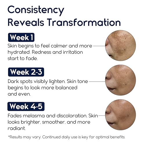 Melasma Treatment for Face - Melasma Cream & Dark Spot Remover - Post-Blemish & Skin Discoloration - Variation: Melasma Cream