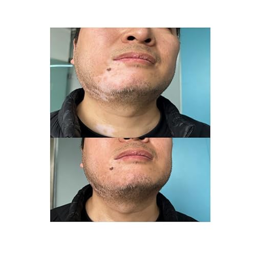ZHEHZI Vitiligo Concealer Pen, Waterproof Skin Concealer, Long-Lasting 3-7 Days, Face& Hands& legs &Body Coverage, full coverage and suitable for all kind of skin, 3.5g (dark skin, hands and feet)