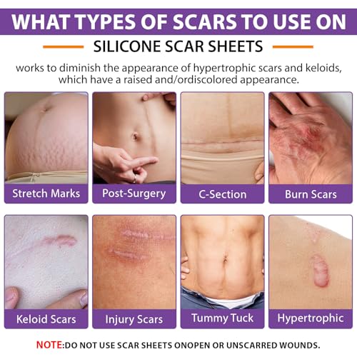 Silicone Scar Sheets, Silicone Sheets for Scars, Silicone Scar Tape for Surgical Scars, Medical Grade Scar Tape for Acne Scar Treatment, Stretch Marks, Tummy Tuck (1.6¡±x 60¡±), Roll-1.5M