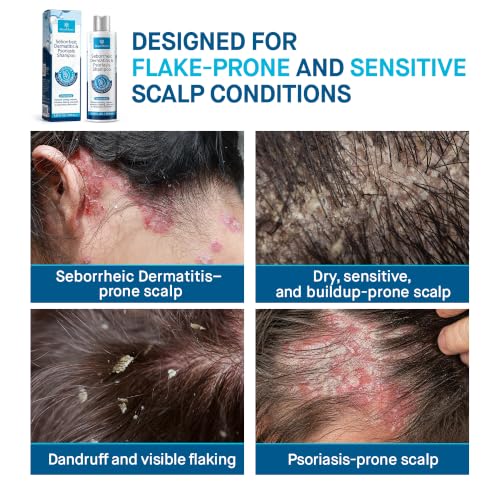 Roycederm Seborrheic Dermatitis & Psoriasis Medicated Shampoo 8.45 Fl Oz