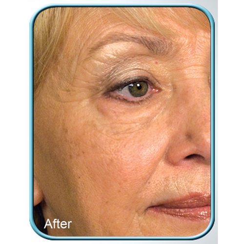 Stem Cell Therapy Cream - Anti-Aging Skin Rejuvenation 1oz Pack of 1