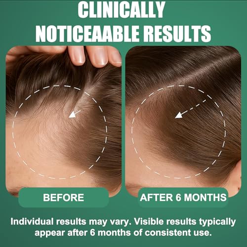 OURMUST Extra Strength 5% Minoxidil Hair Regrowth Spray Pack of 2 - 4.05 Fl Oz Each for Men & Women