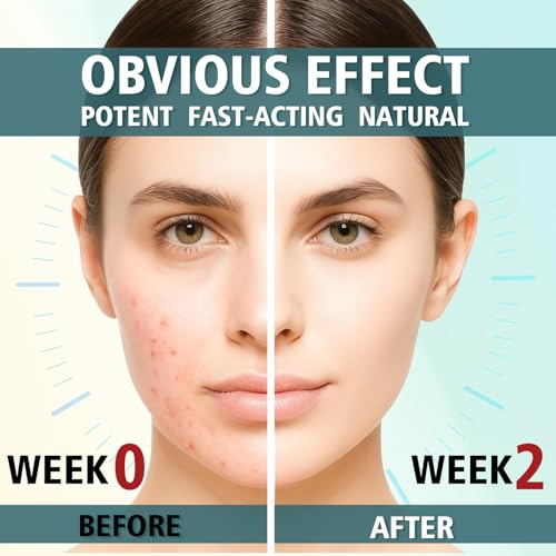 Acne Treatment for Face, Acne Cream, Pimple Cream Suitable for All Skin, Blemish Care Cream for Face and Body, Gentle Daily Skin Care for Oily & Blemish-Prone Skin, Helps Improve Skin Appearance