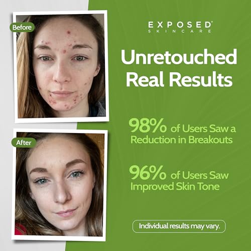 Oil-Free Hydrating Face Moisturizer for Acne-Prone Skin - Brighten & Nourish