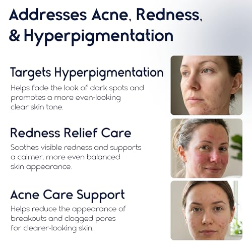 Azelaic Acid 15 Acne Cream for Face - Redness Relief, Rosacea Treatment for Face - Soothes Acne, Hyperpigmentation, Enhanced Formula for Brighter, Healthier Skin Care