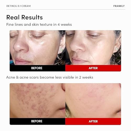 FRANKLY Rejuvenating Duo for Mature Skin ? Retinol 0.1% Cream & Salmon DNA PDRN Serum | Deep Repair & Firming | Korean Skincare | Christmas Gifts for Women