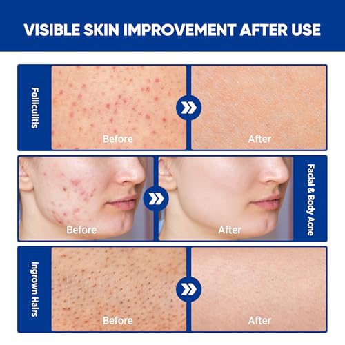 AOSORW Folliculitis & Acne Treatment Cream with Salicylic Acid & Herbal Extracts - 100g for Face, Body & Scalp