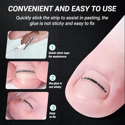 Titanium Alloy Ingrown Toenail Treatment, Nail Tools, and Ingrown Toenail Removal Kit Specially Designed for Curved Nail Repair and Ingrown Toenail Corrector (0.59/0.67in)