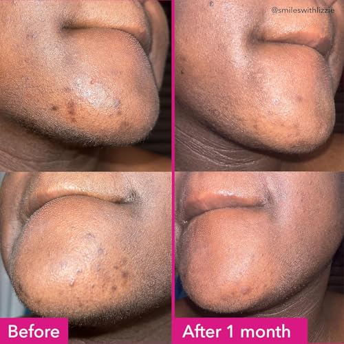 Good Molecules Brightening & Dark Spots Bar Pack 6 ? 85 g / 3 oz Each | Soap Free Face & Body Cleansing Bar with Tranexamic Acid, Kojic Acid & Niacinamide