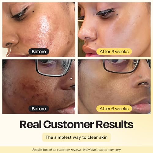 Gleamin Vitamin C Clay Mask for Dark Spots - Brightening Clay Face Mask with Turmeric, Deep Cleansing & Pore Refining Treatment, Helps Improve Uneven Tone & Post-Blemish Texture, 2.5 oz Up to 20 Uses