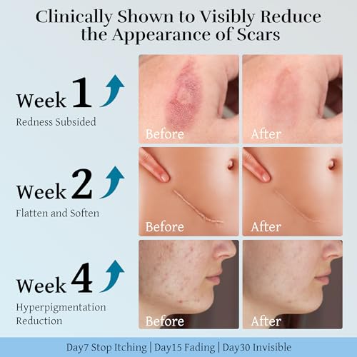 Silicone Scar Cream, Scar Treatment for Improves Skin Texture & Helps Remove Acne, Stretch Marks, Surgery, C Section, Burn, Keloid & Hypertrophic Scars 1.76 Oz (50g)