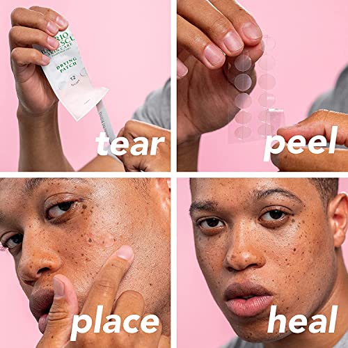 Mario Badescu Powerful Blemish Spot Solution Skin Care Set - Drying Lotion, Deep Blemish Solution & Drying Patch with Salicylic Acid, Zinc Oxide & Niacinamide for Surface & Deep Imperfection