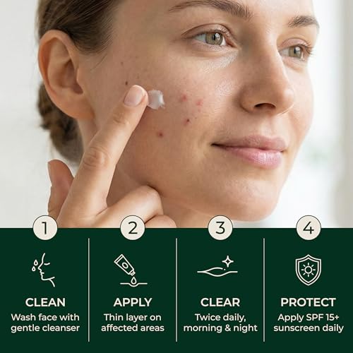 Acne Treatment Cream with 2% Salicylic Acid for Sensitive Skin