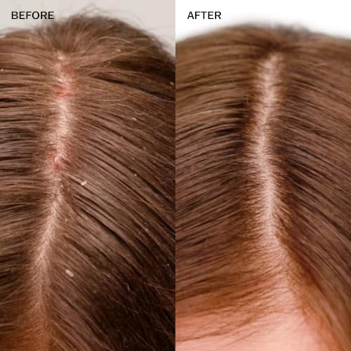 Anti-Dandruff Scalp Shampoo for Dry & Flaky Scalp - 8.4 oz - Soothing Relief with Salicylic & Lactic Acid - Vegan & Cruelty-Free