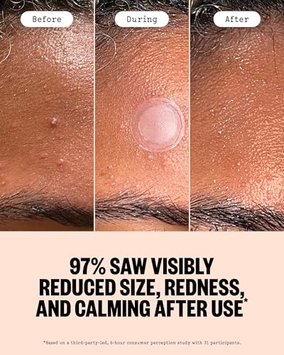 Acne Patches for Early Breakouts - Microneedling Hydrocolloid Dots, 8 Count
