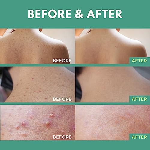 Back Acne Spray with Salicylic Acid & Tea Tree Oil - Body Acne Treatment, 4 oz