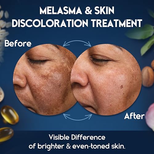 Melasma Treatment for Face - Melasma Cream & Dark Spot Remover - Post-Blemish & Skin Discoloration - Variation: Melasma Cream