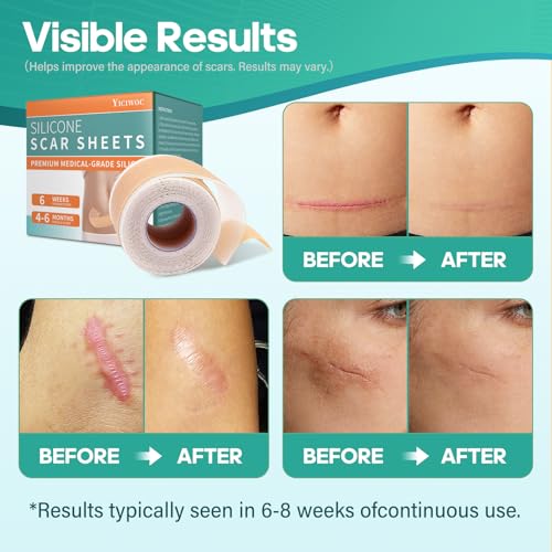 Silicone Gel Patch, Scar Removal Tape for C-Section£¬Surgical£¬Tummy Tuck£¬Burn, Acne, Keloid Bump Removal(1.6"X 120" Roll-3M) Surgery Recovery Items£¬Reusable Scar Away Silicone Sheets