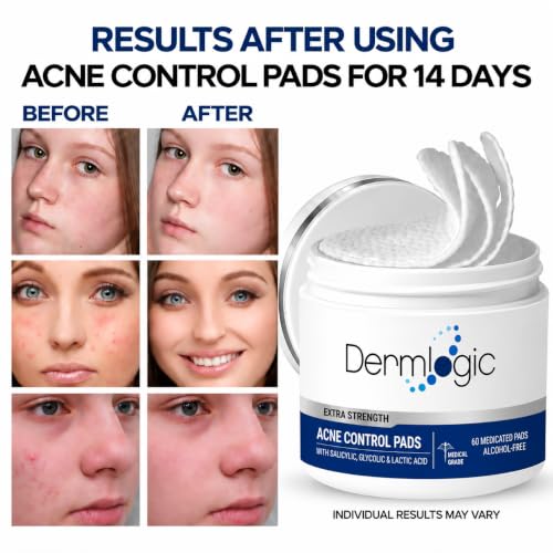 Acne Treatment Pads with Glycolic Lactic Salicylic Acid for Face & Body