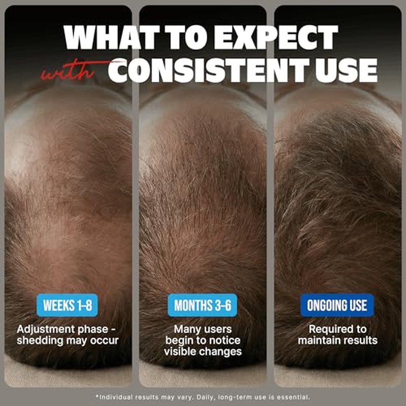 Minoxidil-5% Extra Strength Hair Regrowth for Men, 6 Month Supply