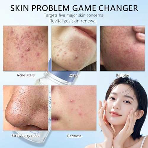 Salicylic Acid Drying Lotion ? Improve Skin Condition, Oil Control, Gentle Skincare for Sensitive Skin 10ml/0.35fl.Oz (2pc)