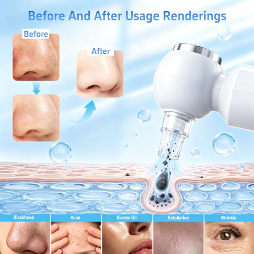 Blackhead Remover Vacuum with Hot Compress and 6 Interchangeable Probes